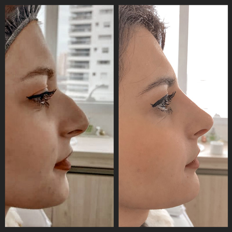 Antes e depois — Rinomodelação — antes e depois na Clínica Sensitivity, Osasco