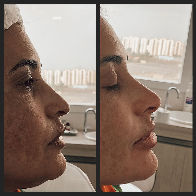 Antes e depois — Rinomodelação — antes e depois na Clínica Sensitivity, Osasco