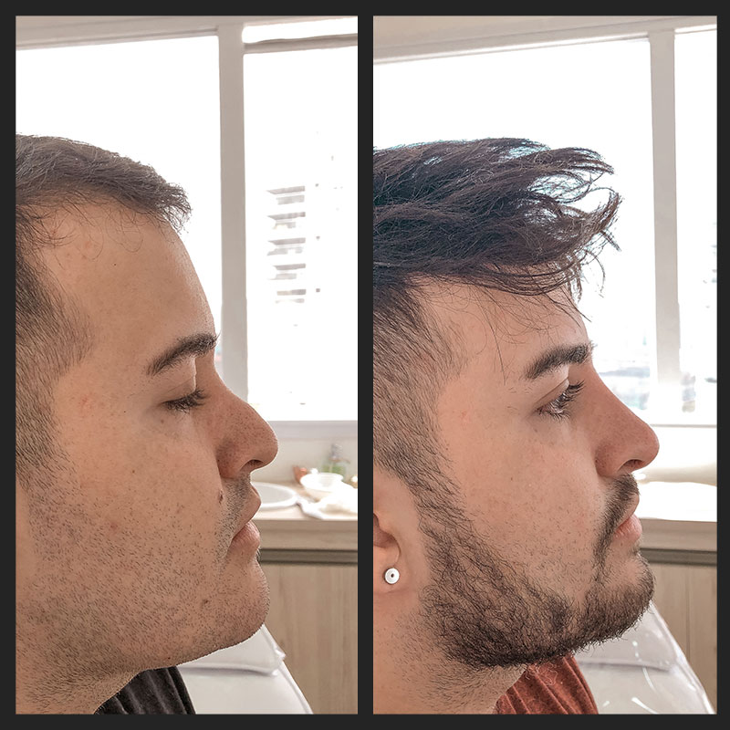 Antes e depois — Rinomodelação — antes e depois na Clínica Sensitivity, Osasco